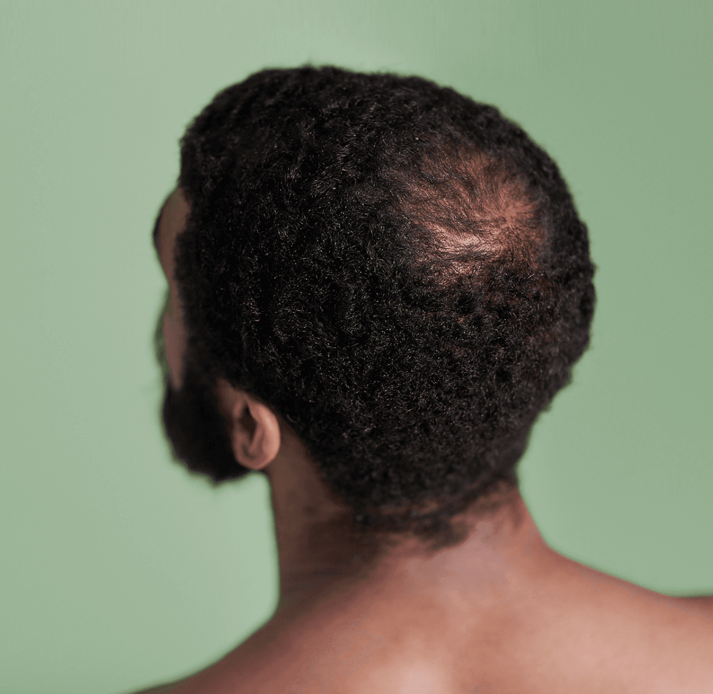 Hair Loss Treatment